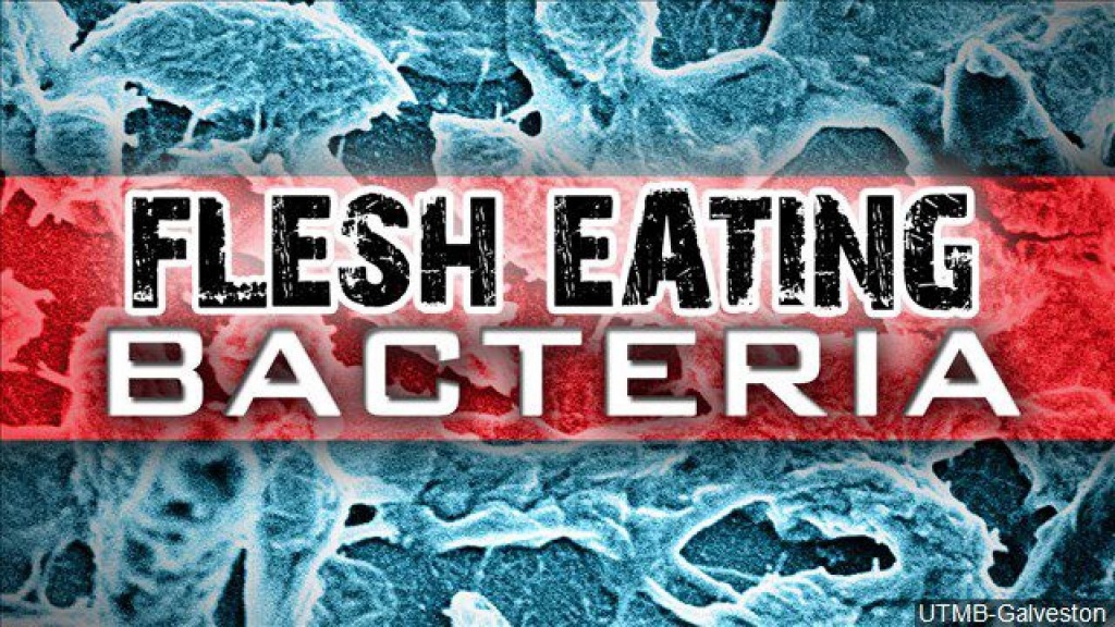 Fourth Case Of Flesh-Eating Bacteria Confirmed In Mobile County - Flesh Eating Bacteria Florida 2017 Map